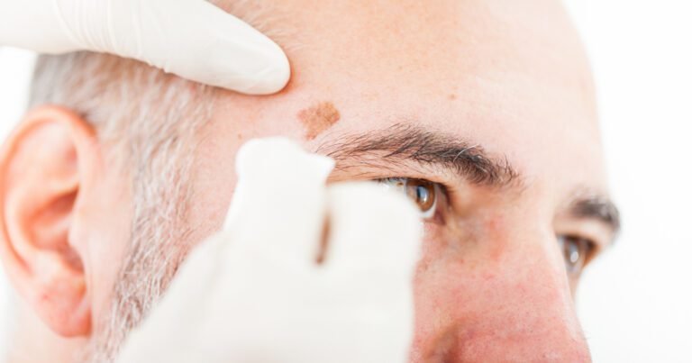 Cómo prevenir y detectar a tiempo el tumor cutáneo más peligroso